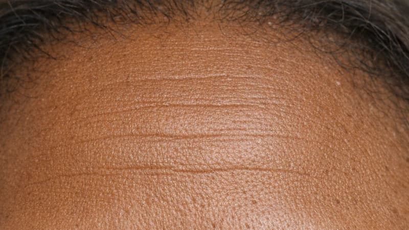 Subtle horizontal lines across a woman's forehead