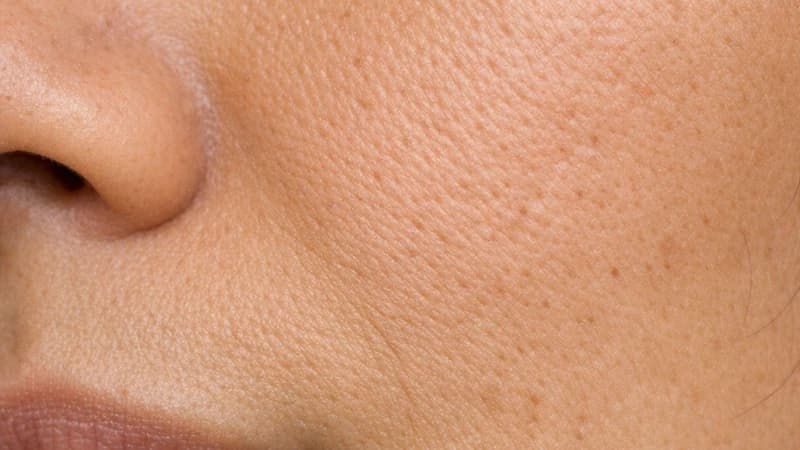 Close-up of a cheek with visible pores and uneven surface texture